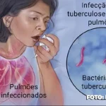 Tuberculose em destaque: Orientações e suporte em São Gonçalo