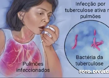Tuberculose em destaque: Orientações e suporte em São Gonçalo