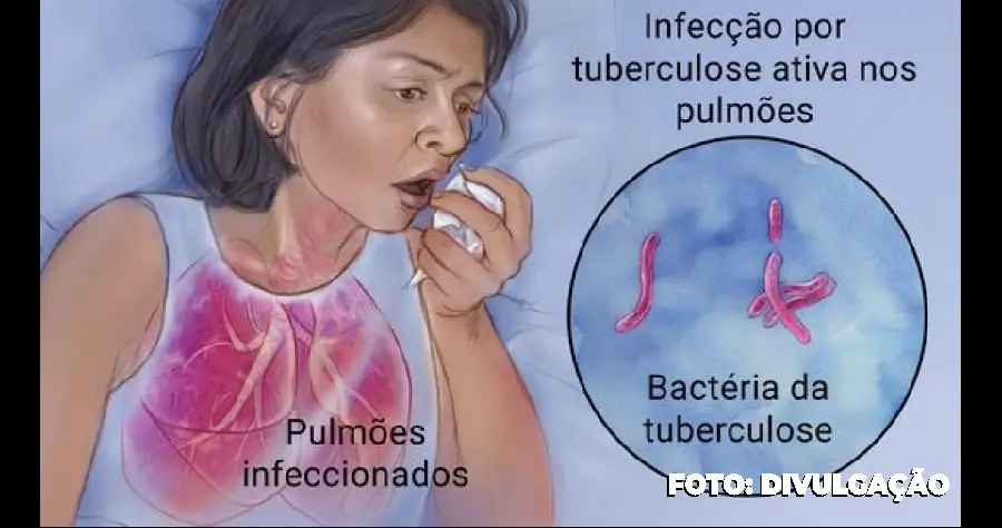 Tuberculose em destaque: Orientações e suporte em São Gonçalo