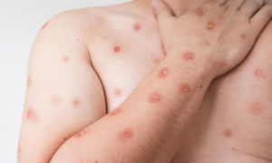 Estado do Rio registra 15 casos confirmados de mpox em 2026. Secretaria de Saúde reforça monitoramento e orientações à população.