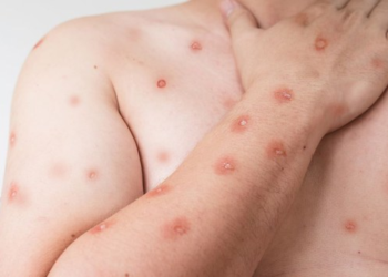 Estado do Rio registra 15 casos confirmados de mpox em 2026. Secretaria de Saúde reforça monitoramento e orientações à população.