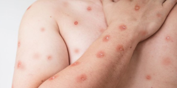Estado do Rio registra 15 casos confirmados de mpox em 2026. Secretaria de Saúde reforça monitoramento e orientações à população.