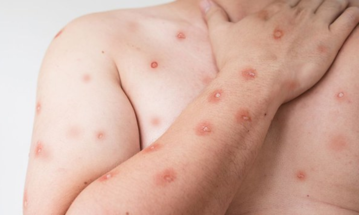 Estado do Rio registra 15 casos confirmados de mpox em 2026. Secretaria de Saúde reforça monitoramento e orientações à população.