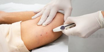 Itaguaí inicia oferta do implante contraceptivo subdérmico para moradores do SUS