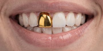 Uso de ouro na odontologia: história, cultura e mudanças na estética dentária