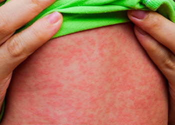 Primeiro caso de sarampo em São Paulo em 2026 é de bebê não vacinado que esteve na Bolívia