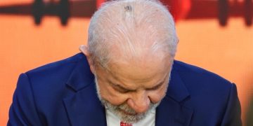 Lula realiza cirurgia para remoção de carcinoma basocelular no couro cabeludo