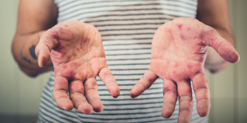 Ministério da Saúde confirma segundo caso de sarampo no Brasil em 2026