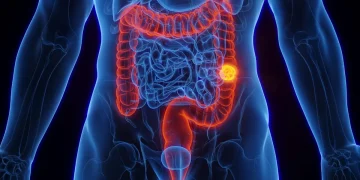 Ministério da Saúde incorpora teste imunocromático fecal ao SUS para detecção do câncer de intestino
