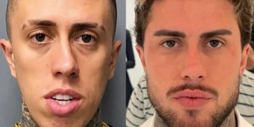 MC Daniel revela resultado de harmonização facial após longo processo de mudanças